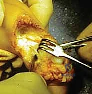 صورة توضيحية لـ عمليات بتر سيم وبويد الدقيقة لعلاج نقص عظم الشظية الخلقي: دليل شامل للمرضى