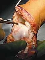 صورة توضيحية لـ عمليات بتر سيم وبويد الدقيقة لعلاج نقص عظم الشظية الخلقي: دليل شامل للمرضى