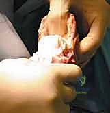 صورة طبية: عمليات بتر سيم وبويد الدقيقة لعلاج نقص عظم الشظية الخلقي: دليل شامل للمرضى