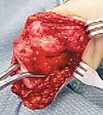 صورة توضيحية لـ عمليات بتر سيم وبويد الدقيقة لعلاج نقص عظم الشظية الخلقي: دليل شامل للمرضى