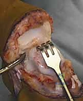 صورة طبية: عمليات بتر سيم وبويد الدقيقة لعلاج نقص عظم الشظية الخلقي: دليل شامل للمرضى