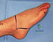 فصل الأنسجة الرخوة بعناية