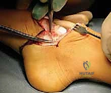 صورة توضيحية لـ عمليات بتر سيم وبويد الدقيقة لعلاج نقص عظم الشظية الخلقي: دليل شامل للمرضى