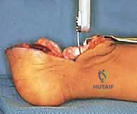 صورة توضيحية لـ عمليات بتر سيم وبويد الدقيقة لعلاج نقص عظم الشظية الخلقي