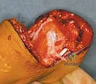 صورة طبية: عمليات بتر سيم وبويد الدقيقة لعلاج نقص عظم الشظية الخلقي: دليل شامل للمرضى