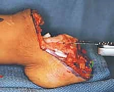 التخطيط الجراحي المبكر لحالة نقص الشظية