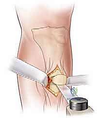 صورة طبية: عمليات بتر سيم وبويد الدقيقة لعلاج نقص عظم الشظية الخلقي: دليل شامل للمرضى