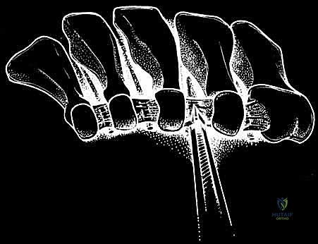 Uniportal Endoscopic Decompression of the Interdigital Nerve for Morton's Neuroma: A Surgical Masterclass