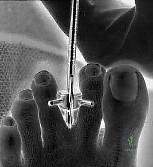 التشريح الدقيق لموقع ورم مورتون وانضغاط العصب