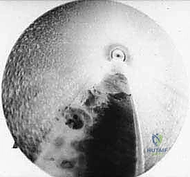 لحظة قطع الرباط المستعرض وتحرير العصب بواسطة المنظار