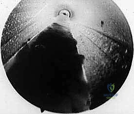 الفحص السريري الدقيق لورم مورتون