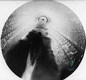 إدخال أدوات المنظار الدقيقة عبر الشق الصغير
