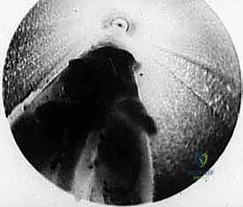 الأدوات الجراحية الدقيقة المستخدمة في جراحة المنظار
