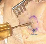 Illustration of fresh osteochondral allografts - Dr. Mohammed Hutaif