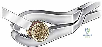 تحضير سرير العيب الغضروفي وحفر العظم التالف