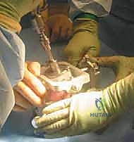 تجهيز الطعم الغضروفي العظمي في غرفة العمليات