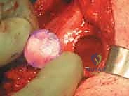 صورة توضيحية لـ زراعة الطعوم الغضروفية العظمية: حل متقدم لاستعادة غضروف الركبة على يد الأستاذ الدكتور محمد هطيف في صنعاء