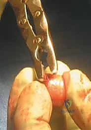 صورة توضيحية لـ زراعة الطعوم الغضروفية العظمية: حل متقدم لاستعادة غضروف الركبة على يد الأستاذ الدكتور محمد هطيف في صنعاء