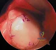 صورة توضيحية لـ زراعة الطعوم الغضروفية العظمية: حل متقدم لاستعادة غضروف الركبة على يد الأستاذ الدكتور محمد هطيف في صنعاء