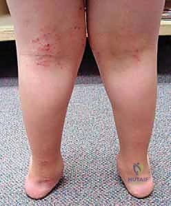 صورة توضيحية لـ تشوه الكاحل الإفحجي (القدم المسطحة): دليل شامل وعلاج بتقنية تعديل النمو الموجه مع الأستاذ الدكتور محمد هطيف