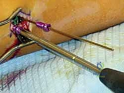 صورة توضيحية لـ تشوه الكاحل الإفحجي (القدم المسطحة): دليل شامل وعلاج بتقنية تعديل النمو الموجه