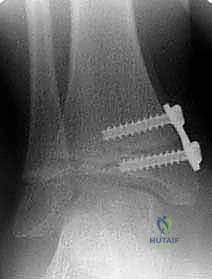 صورة توضيحية لـ تشوه الكاحل الإفحجي (القدم المسطحة): دليل شامل وعلاج بتقنية تعديل النمو الموجه مع الأستاذ الدكتور محمد هطيف