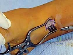 صورة توضيحية لـ تشوه الكاحل الإفحجي (القدم المسطحة): دليل شامل وعلاج بتقنية تعديل النمو الموجه مع الأستاذ الدكتور محمد هطيف