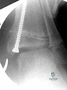 Illustration of hemiepiphysiodesis for ankle - Dr. Mohammed Hutaif
