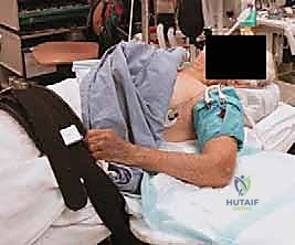 صورة توضيحية لـ خلع الكوع الكسري المعقد (الثالوث الرهيب): دليل شامل للعلاج والتعافي مع الأستاذ الدكتور محمد هطيف