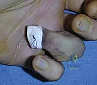 Surgical technique step for Operative Treatment of Distal Interphalangeal Joint Fracture-Dislocations