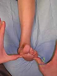 وضع القدم في الوضع المحايد أثناء الفحص السريري لتحديد تشوه مقدمة القدم