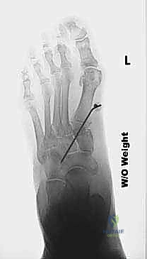 التخطيط الجراحي الدقيق لجراحة كوتون وتحديد زاوية القطع العظمي