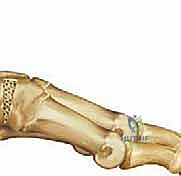 إجراء القطع العظمي بدقة متناهية باستخدام المنشار الجراحي الدقيق