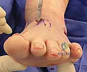 مراحل تطور تشوه القدم المسطحة الأروح وتأثيرها على مفاصل القدم