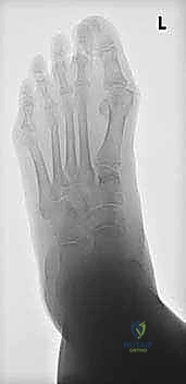 صورة توضيحية لـ جراحة كوتون (Plantarflexion Osteotomy): حل متقدم لتشوه القدم المسطحة في صنعاء مع الأستاذ الدكتور محمد هطيف