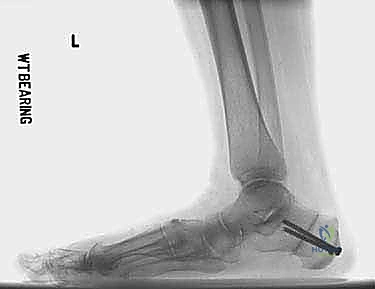 صورة توضيحية لـ جراحة كوتون (Plantarflexion Osteotomy): حل متقدم لتشوه القدم المسطحة في صنعاء مع الأستاذ الدكتور محمد هطيف