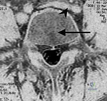 توضيح لمرض القرص التنكسي والانزلاق الغضروفي