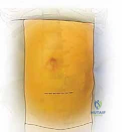 صورة توضيحية لـ النهج الأمامي للعمود الفقري القطني: علاج متقدم لآلام الظهر المزمنة في صنعاء