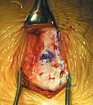 التحضير لقرار التدخل الجراحي للعمود الفقري