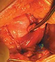 إدخال الدعامة (Cage) بين الفقرات