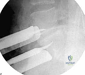 صورة توضيحية لـ النهج الأمامي للعمود الفقري القطني: علاج متقدم لآلام الظهر المزمنة في صنعاء