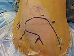 Illustration of treatment of multidirectional - Dr. Mohammed Hutaif