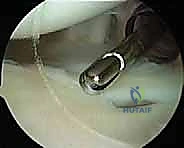 صورة توضيحية لـ إصلاح عدم استقرار الكتف متعدد الاتجاهات بالمنظار: خبرة الأستاذ الدكتور محمد هطيف في شد المحفظة المفصلية