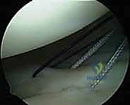 إدخال المنظار الجراحي بدقة عالية 4K إلى مفصل الكتف