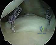 صورة توضيحية لـ إصلاح عدم استقرار الكتف متعدد الاتجاهات بالمنظار: خبرة الأستاذ الدكتور محمد هطيف في شد المحفظة المفصلية