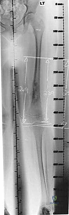 تأثير الورم على نمو العظم
