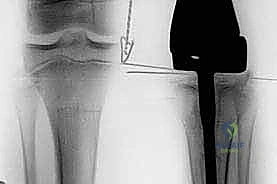 صور الأشعة السينية والرنين المغناطيسي للورم