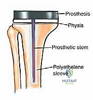 ساركوما إيوينغ في العظام