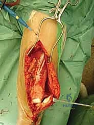 صورة توضيحية لـ إنقاذ الأطراف للأطفال زراعة الأطراف الاصطناعية القابلة للتمدد