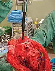 حساب التفاوت في طول الطرفين